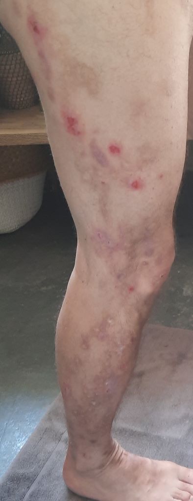 Membre inférieur droit